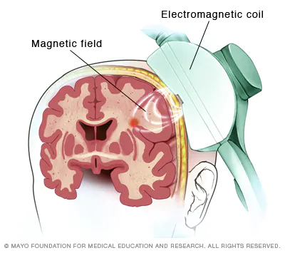 TMS as an electromagnetic therapy for depression 